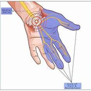 Carpal Tunnel Syndrome Prevention