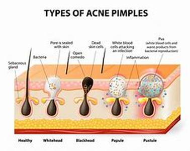 Acne Treatment, The Common Sense Approach