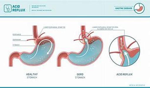 Acidophilus: Acidophilus Supplements May Help Million People with Digestive Diseases