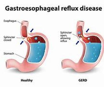 Acidophilus: Lactobacillus Acidophilus ABC