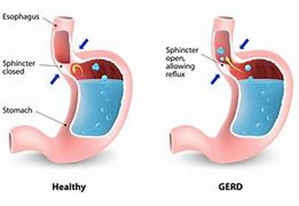 Acid Reflux And Heartburn Natural  Remedies