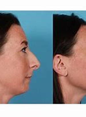 Rhinoplasty in