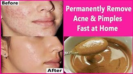 Acne- Can I Treat My Acne By Removing Surface Oils