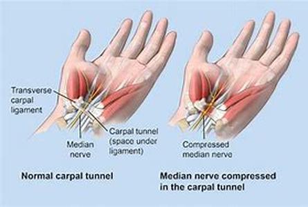 Varied Kinds of Carpal Tunnel Syndrome Treatments