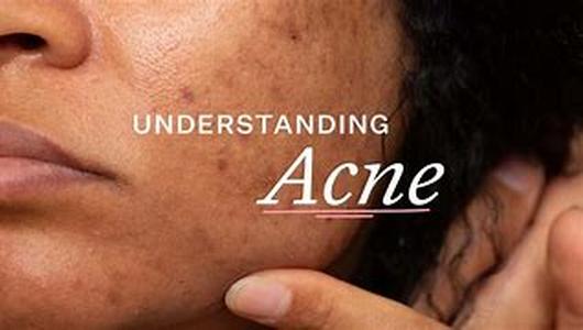 Acne Treatment:  Options For A Solution For Young Women