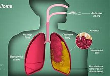 Asbestos Exposure  It is a borne fact that whichever corner you turn to, there are imposing threats which may not seemingly appear as innocuous