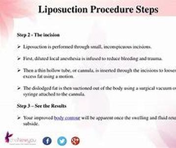 Liposuction -  A Weight Loss Method