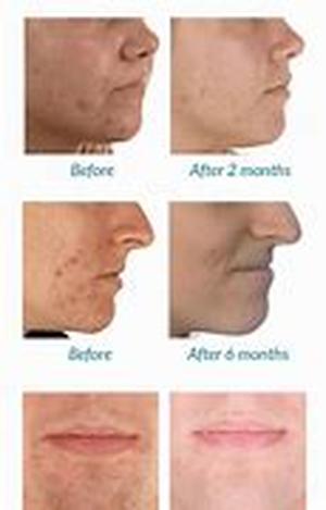 Acne And Its Treatment