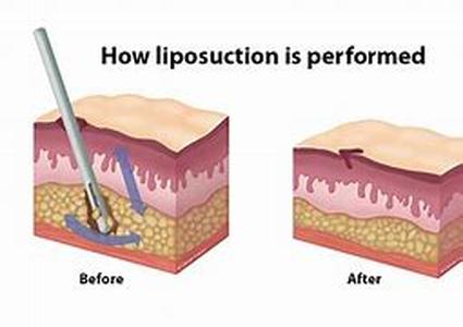 Laser Prostate Treatment on BPH  Now that the prostate has become a world concern, many men approaching 40s and 50s are being persuaded to arrange for themselves an annual routine testing involving prostate problem detection by means of PSA testing and DR