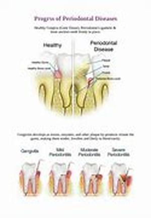 Periodontal disease or gum disease is an infection that irritates the gums and destroys bones where your teeth are anchored