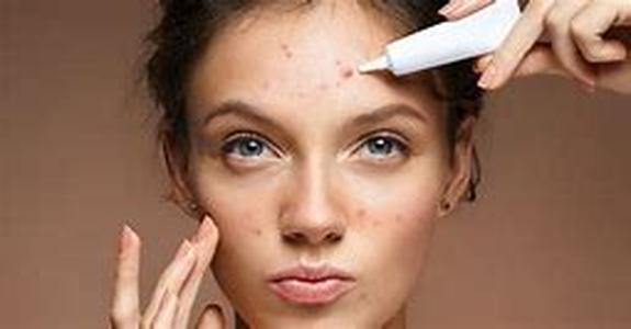 Acne Treatment: How To Fight Bacteria