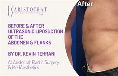 Liposuction For The Reduction of Breasts