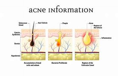 Acne- Treatment Regime For Severe Acne