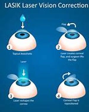 Lasik Surgery