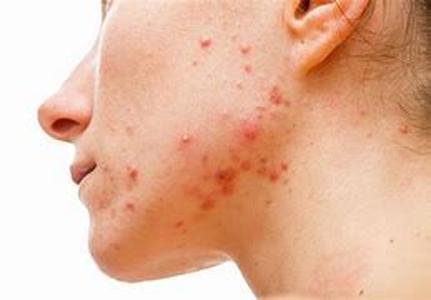 Adult Acne Treatments