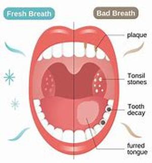 Common Bad Breath Causes  Summary: In knowing the common bad breath causes helps us understand people with this condition