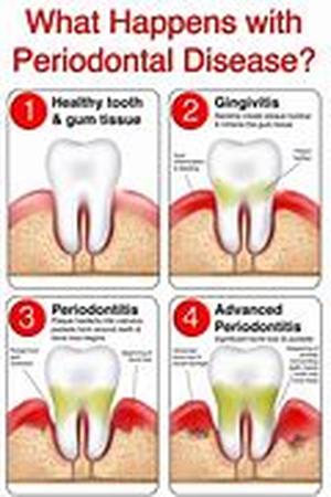 Keyword Phrase: causes gum disease