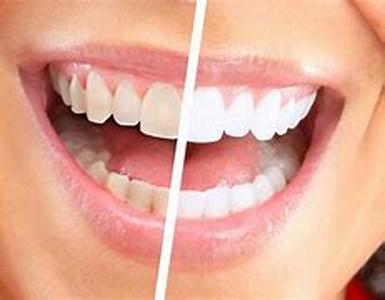 Teeth Whitening Kits: Nothing But the Tooth