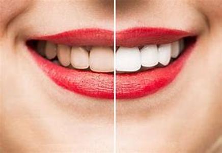 Teeth Whitening Options: When Toothpaste is Not Enough Anymore