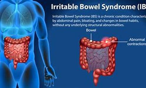 Irritable Bowel Syndrome Signs And Symptoms